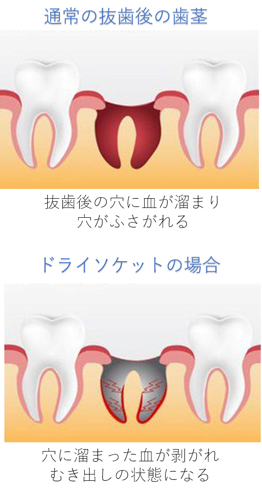 抜歯 後 食べかす