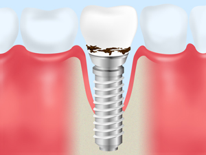 インプラント歯周炎