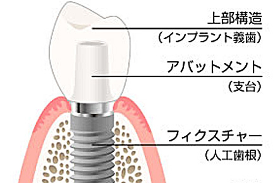 アバットメント（土台）